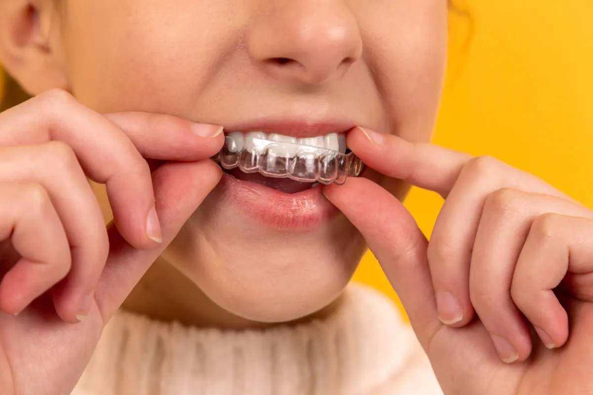 Şeffaf plak (aligner) uygulaması